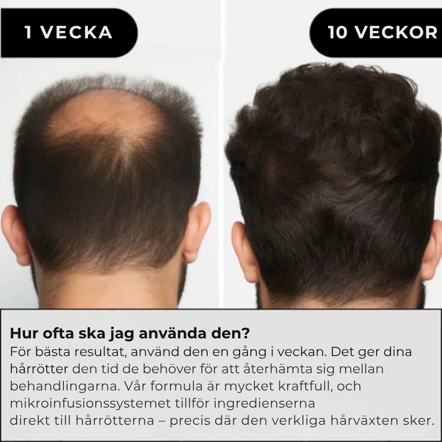 Folira® | Håråterväxtsystem – 1 infusionssystem, 4 serum - Bild 3