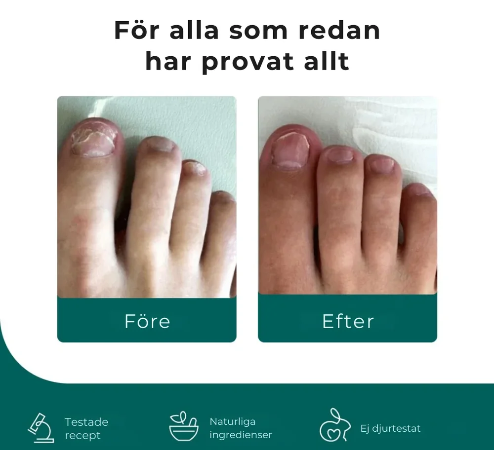 NagelFri® | Sluta gömma dina naglar – bli av med nagelsvamp från roten på bara 12 veckor! - Bild 2