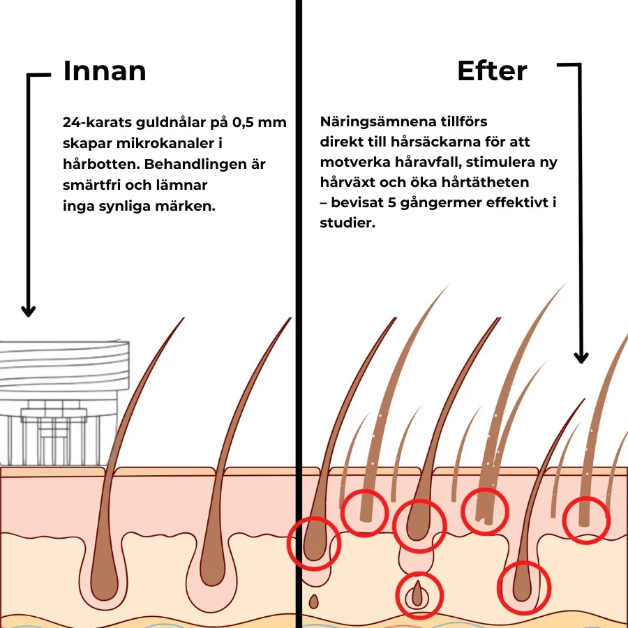 Folira® | Håråterväxtsystem – 1 infusionssystem, 4 serum - Bild 2