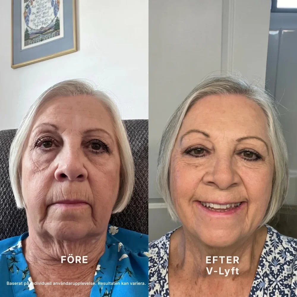 V-Lyft® | Känn dig självsäker igen med en naturligt lyft käklinje på 3 veckor - Bild 2