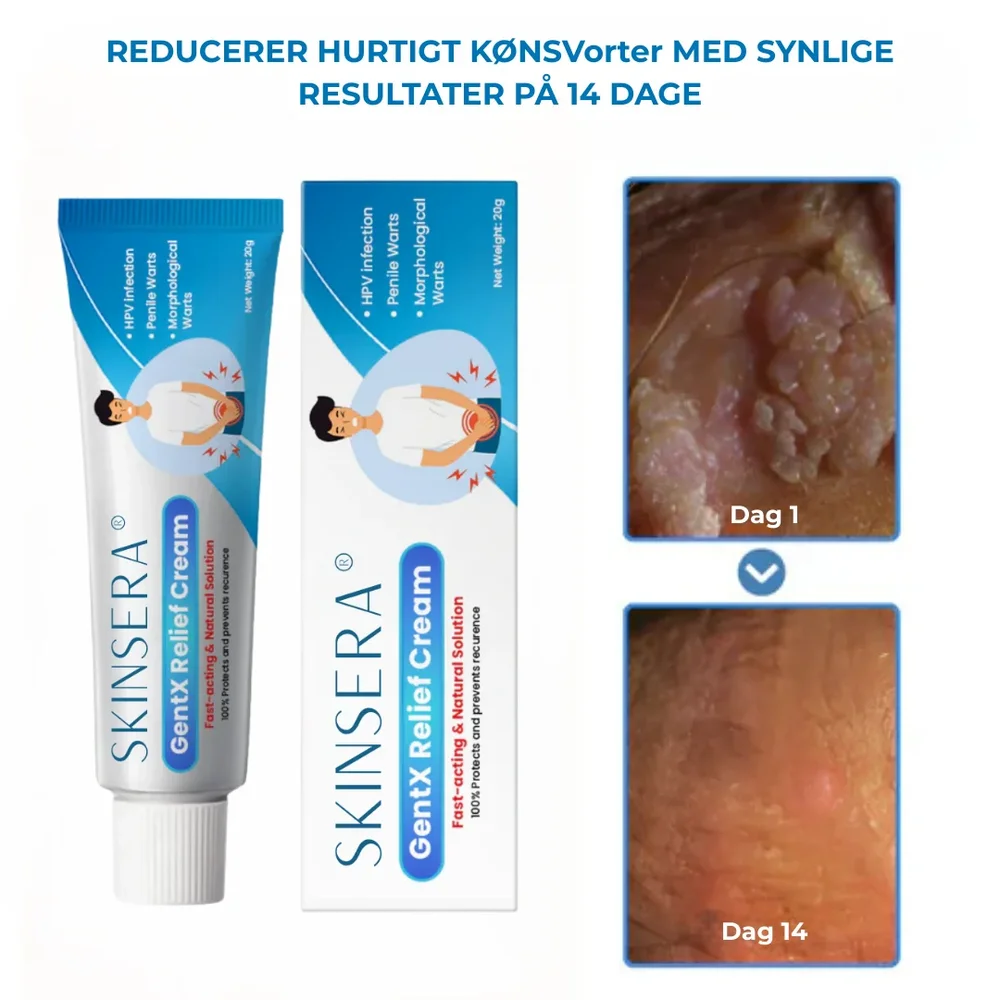 Skinsera® HPV Vårtor Lättnad Kräm - Bild 1