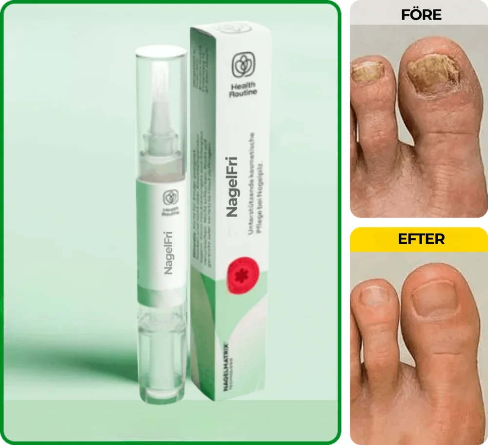 NagelFri® | Sluta gömma dina naglar – bli av med nagelsvamp från roten på bara 12 veckor! - Bild 1