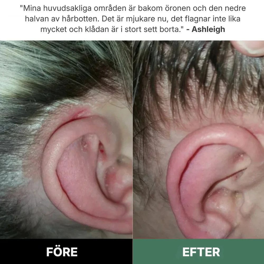 Rootique® | Ett nytt sätt att lindra klåda och fjällande hårbotten – utan steroider - Bild 2