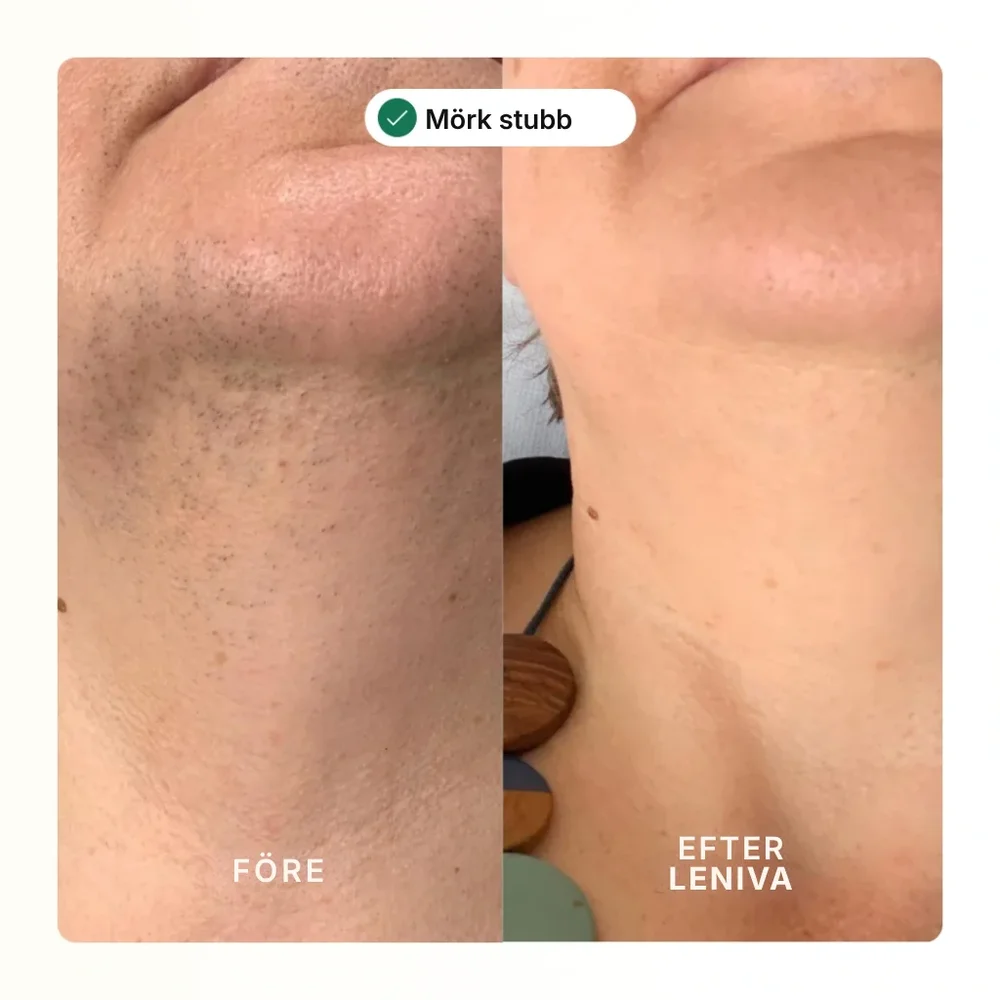 Leniva® | Hårborttagningskräm för ansiktet och lugnande serum - Bild 2