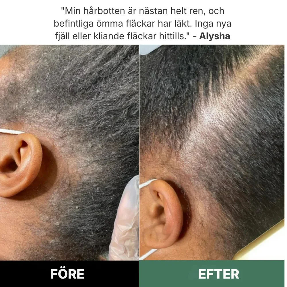 Rootique® | Ett nytt sätt att lindra klåda och fjällande hårbotten – utan steroider - Bild 3